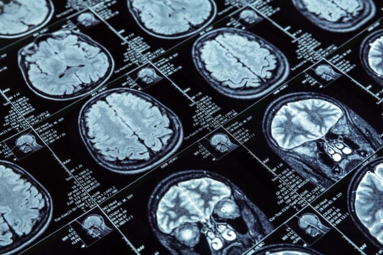 brain scan ai dementia detection