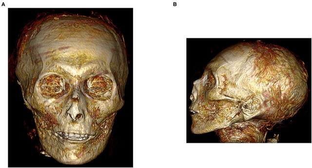 CT Scan of Egyptian King Amenhotep I Mummy