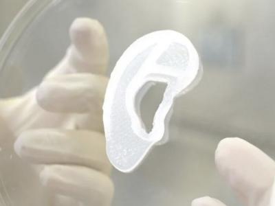20-Year-Old Girl Becomes the First Person to Get a Functional 3D Printed Ear Made of Her Own Tissue!